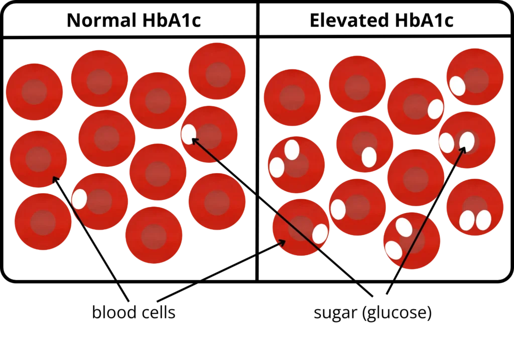 Diagram showing red blood cells with normal and elevated HbA1c levels, including glucose attachment.