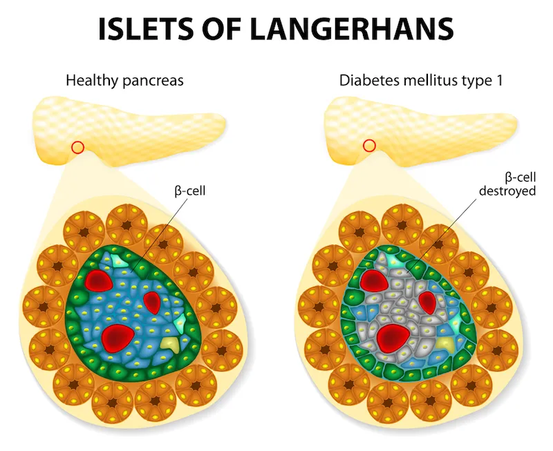 Comparison of healthy and type 1 diabetes-affected islets of Langerhans in the pancreas.