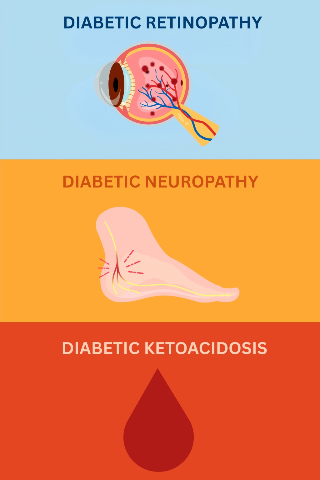 Illustration showing three major complications of type 1 diabetes: diabetic retinopathy, diabetic neuropathy, and diabetic ketoacidosis.