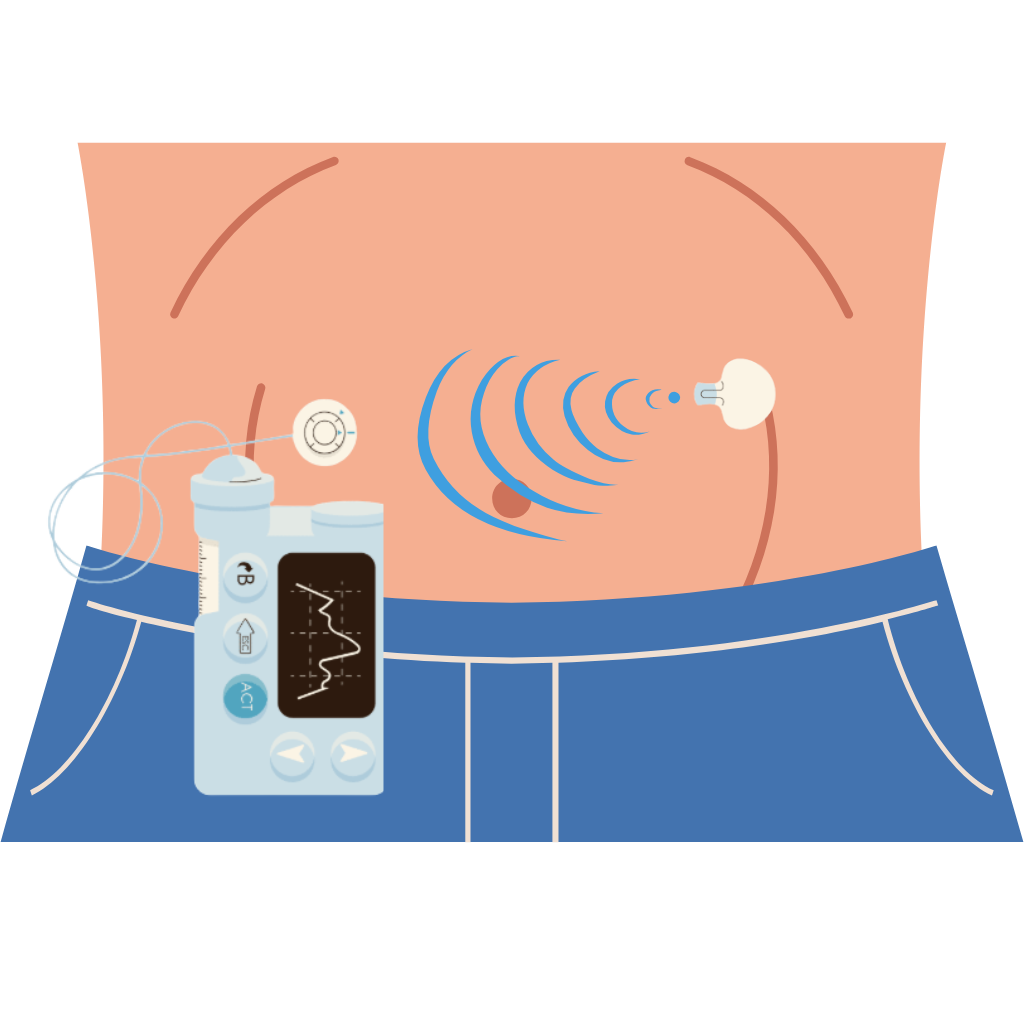 Insulin pump with infusion set and continuous glucose monitor sensor.