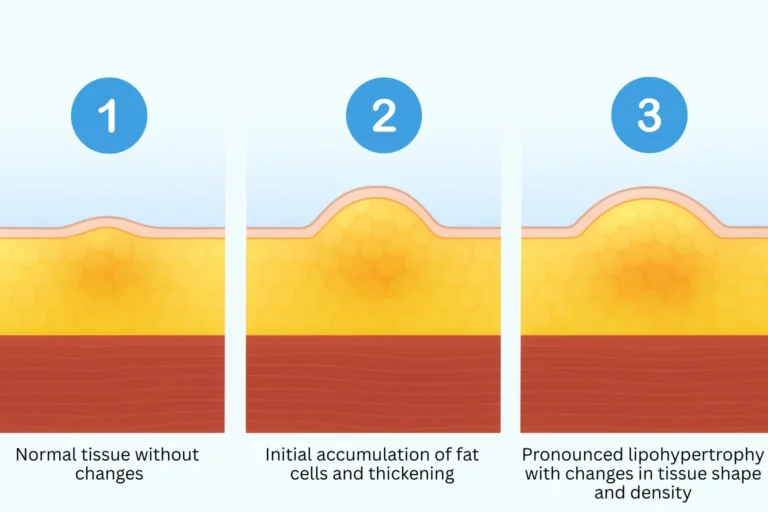 Illustration showing stages of lipohypertrophy under the skin in people using insulin injections.